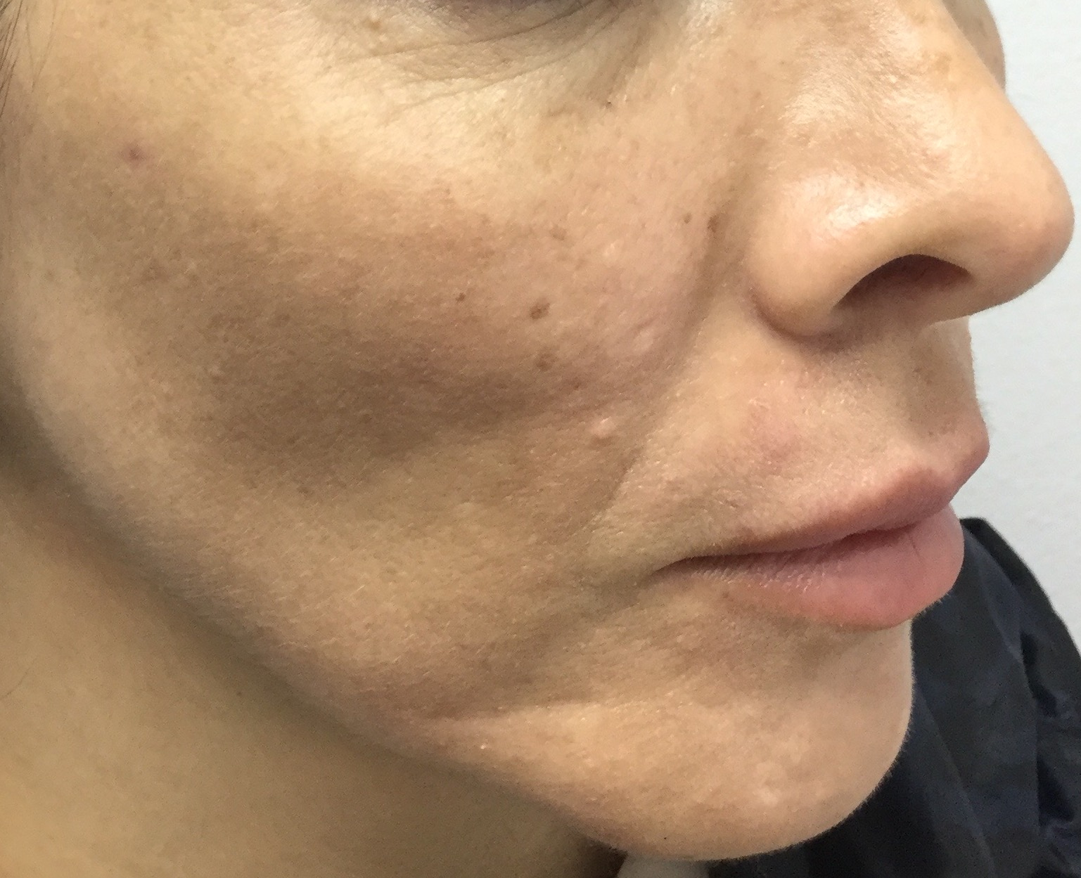 Melasma - Antes del tratamiento